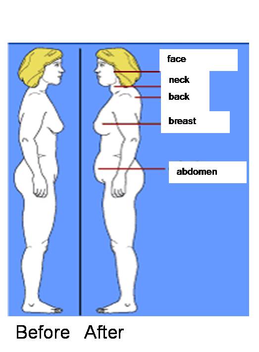 Weight Gain: The Unwanted Side Effect of Prednisone for UC